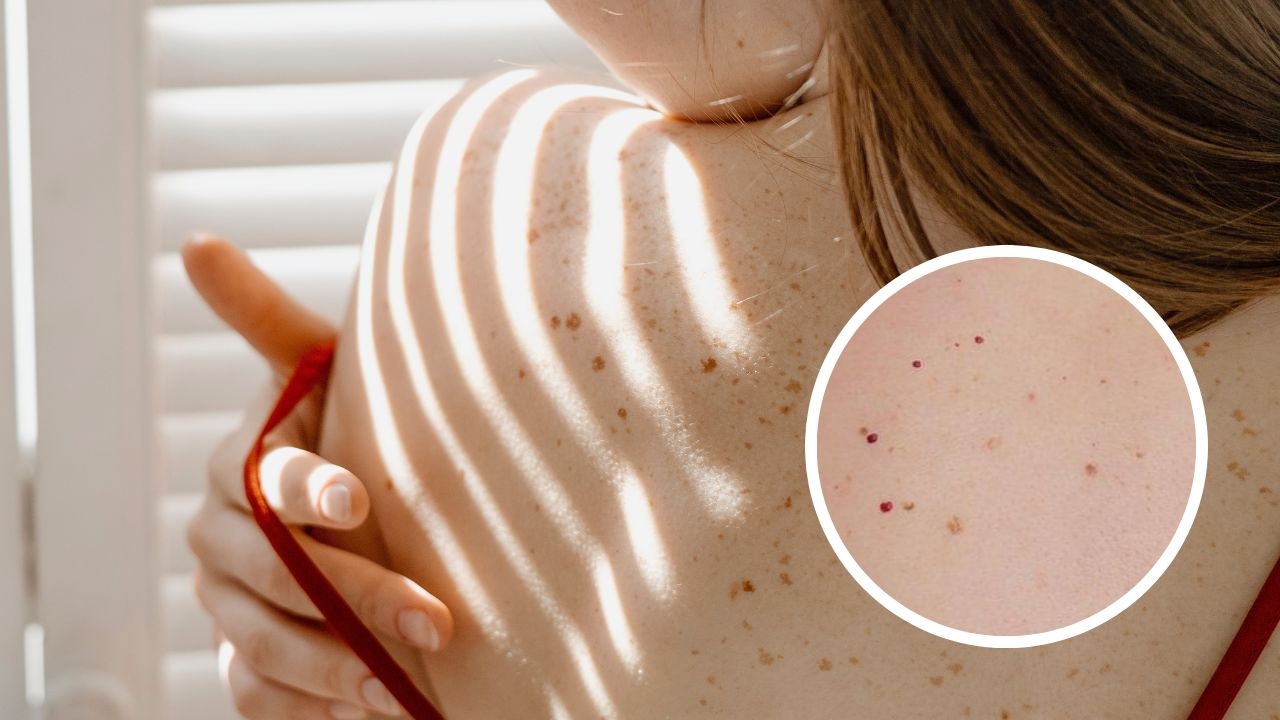 lunares rojos en piel