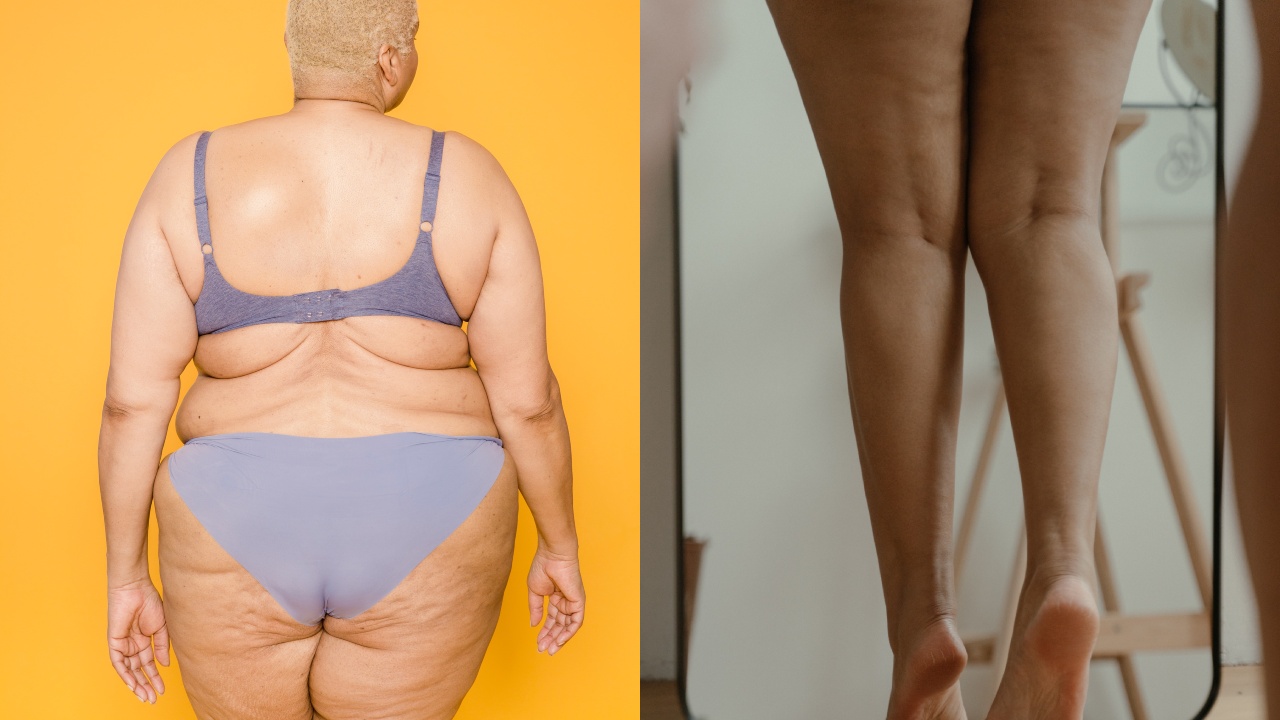 Bicarbonato para eliminar la celulitis