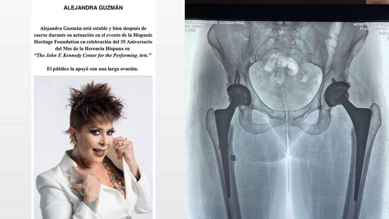 sintomas dislocacion de cadera