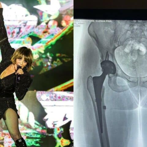 sintomas dislocacion de cadera