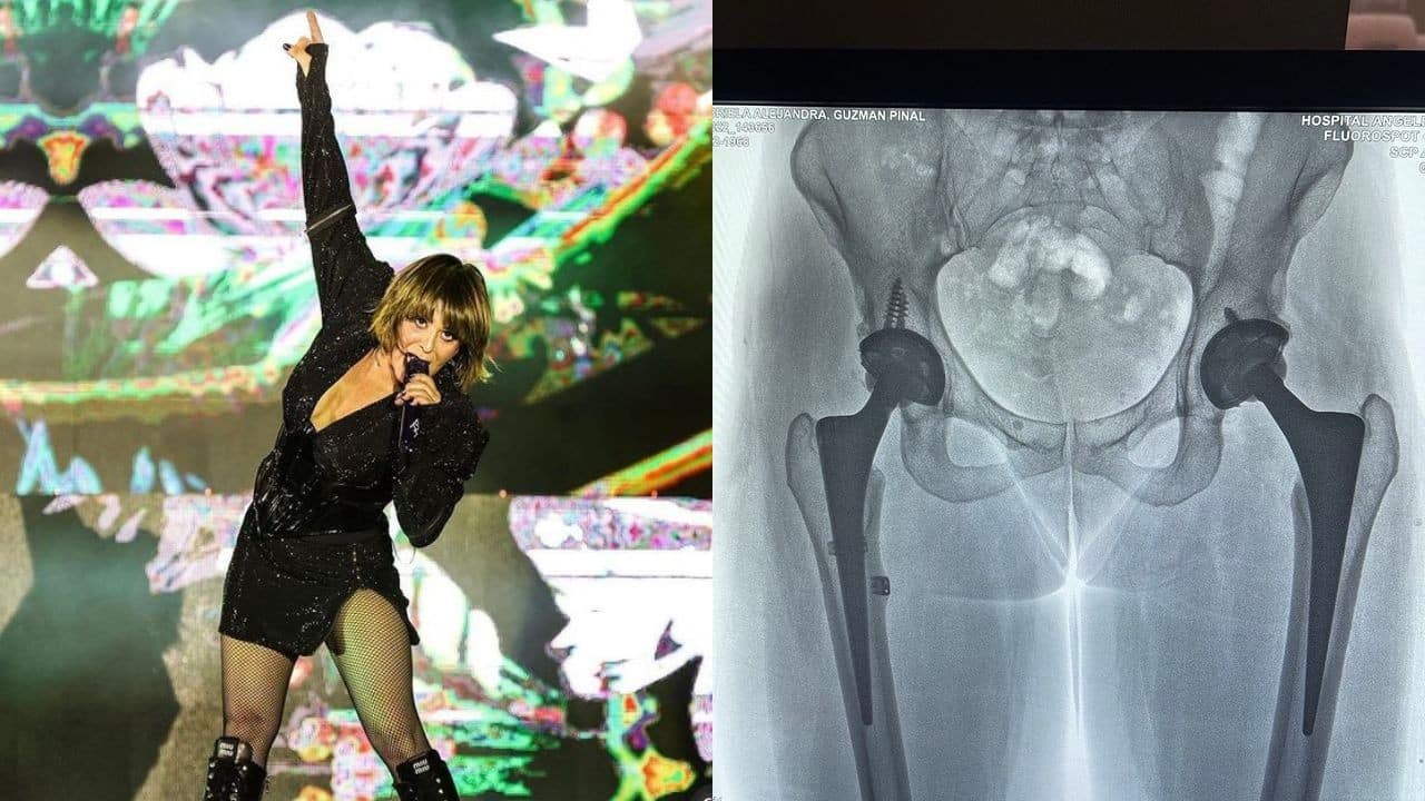 sintomas dislocacion de cadera