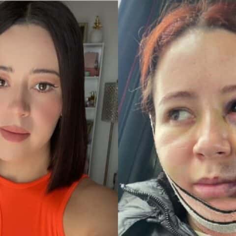 Tiktoker se hace la bichectomía