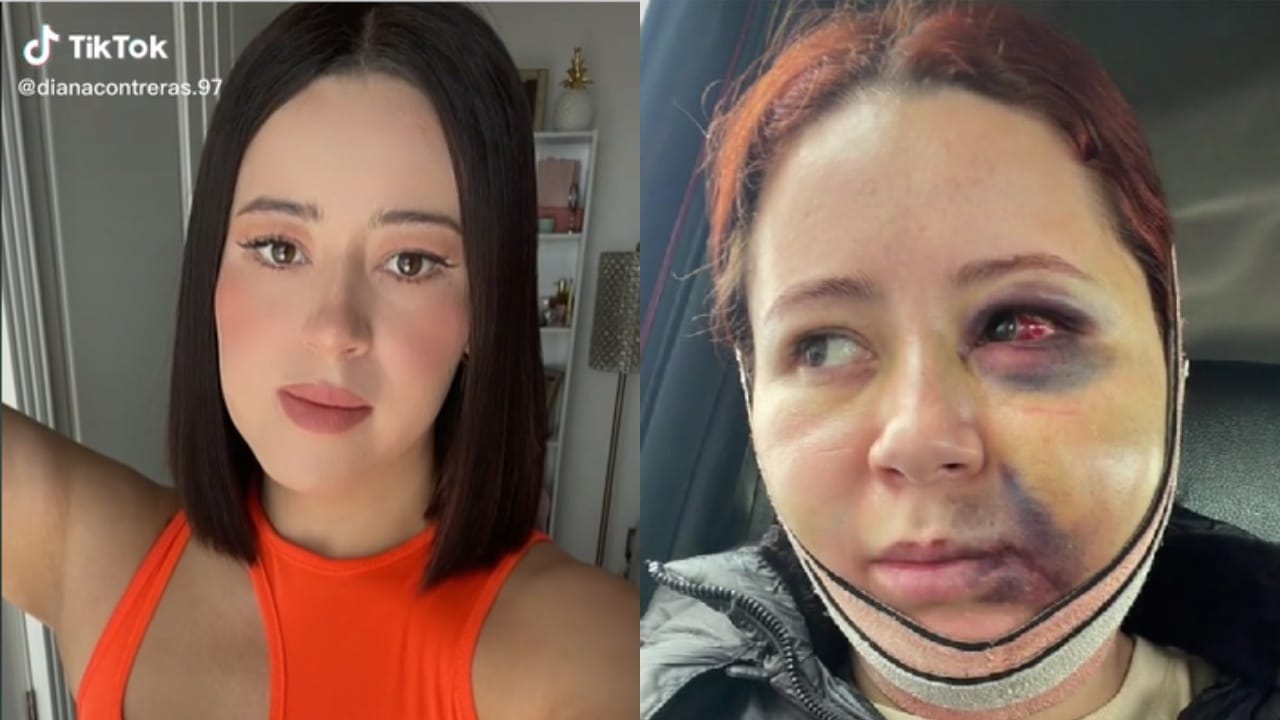 Tiktoker se hace la bichectomía