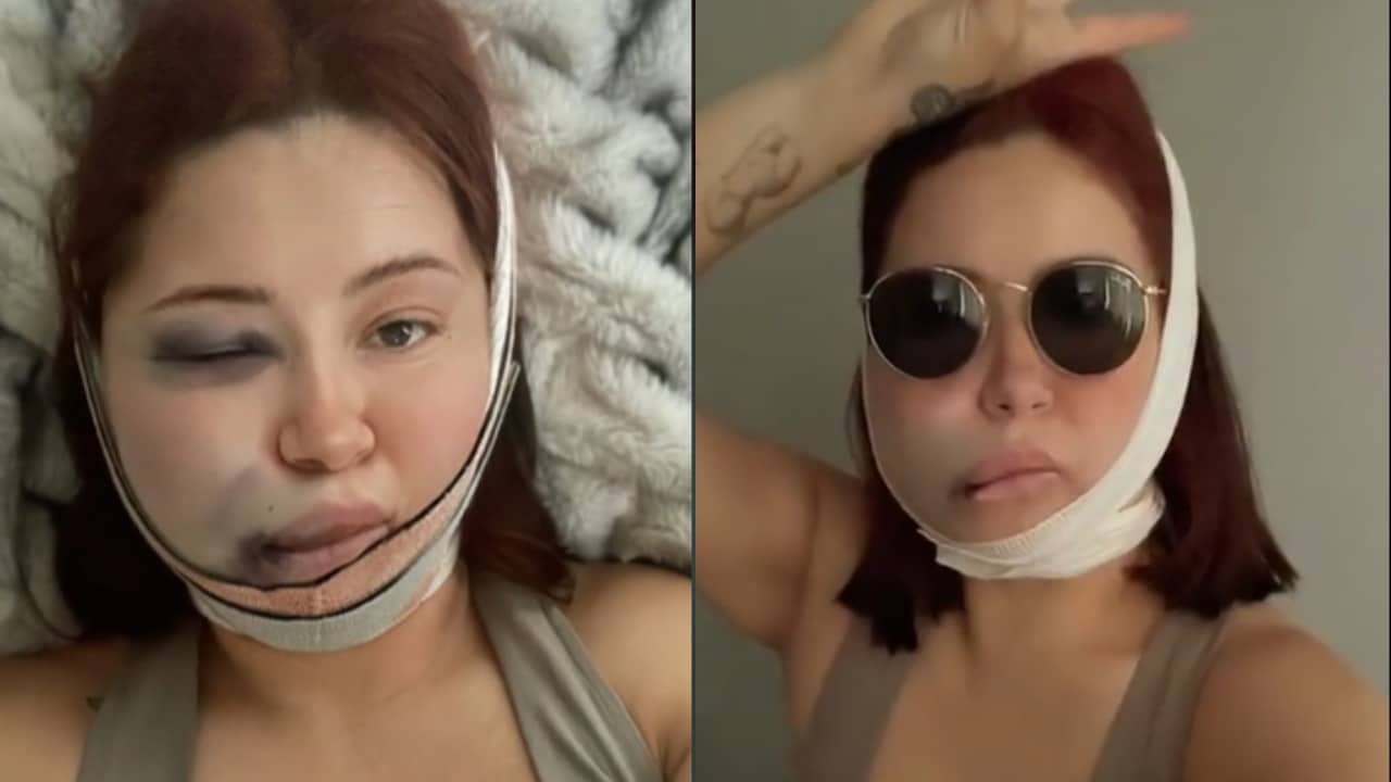 Tiktoker se hace la bichectomía