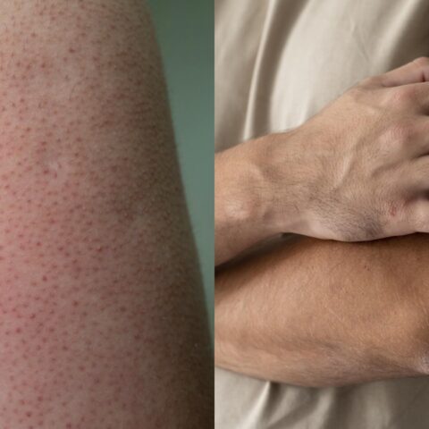 granitos en los brazos