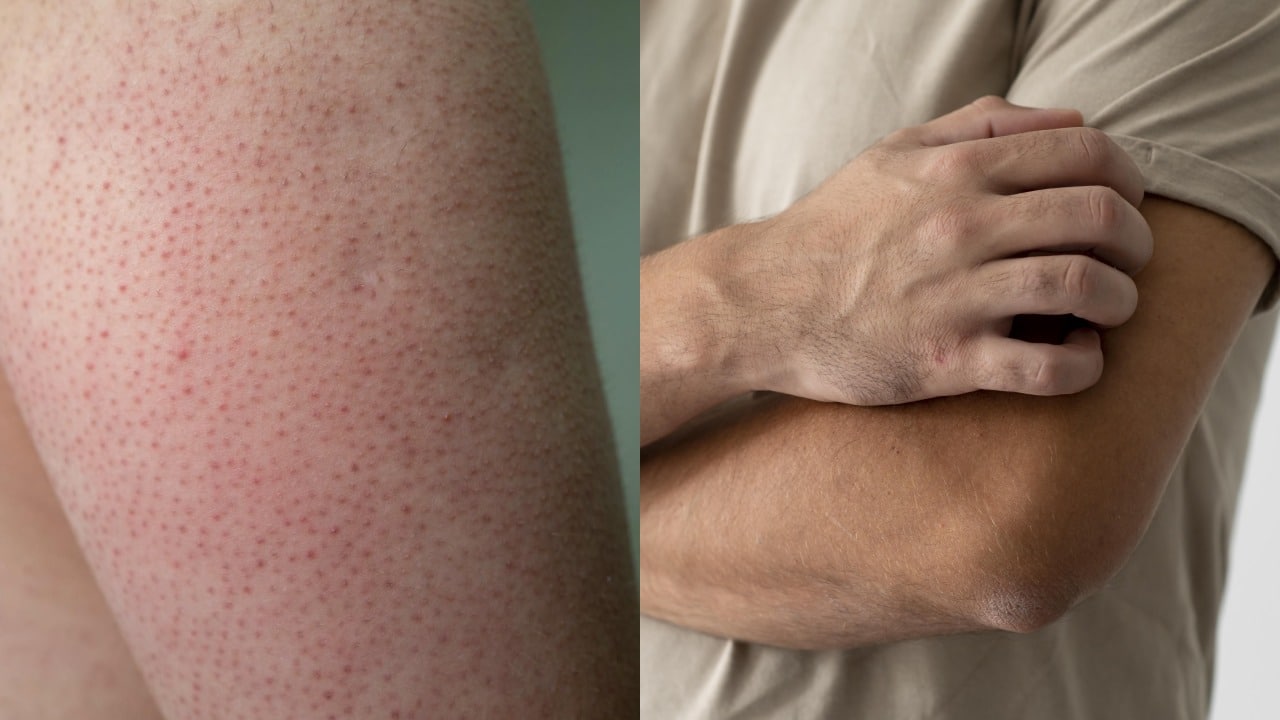 granitos en los brazos