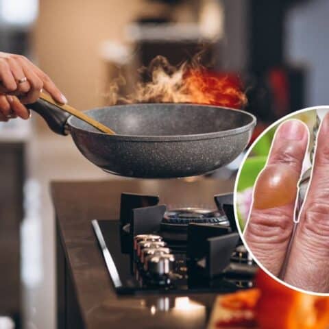 quemaduras de aceite