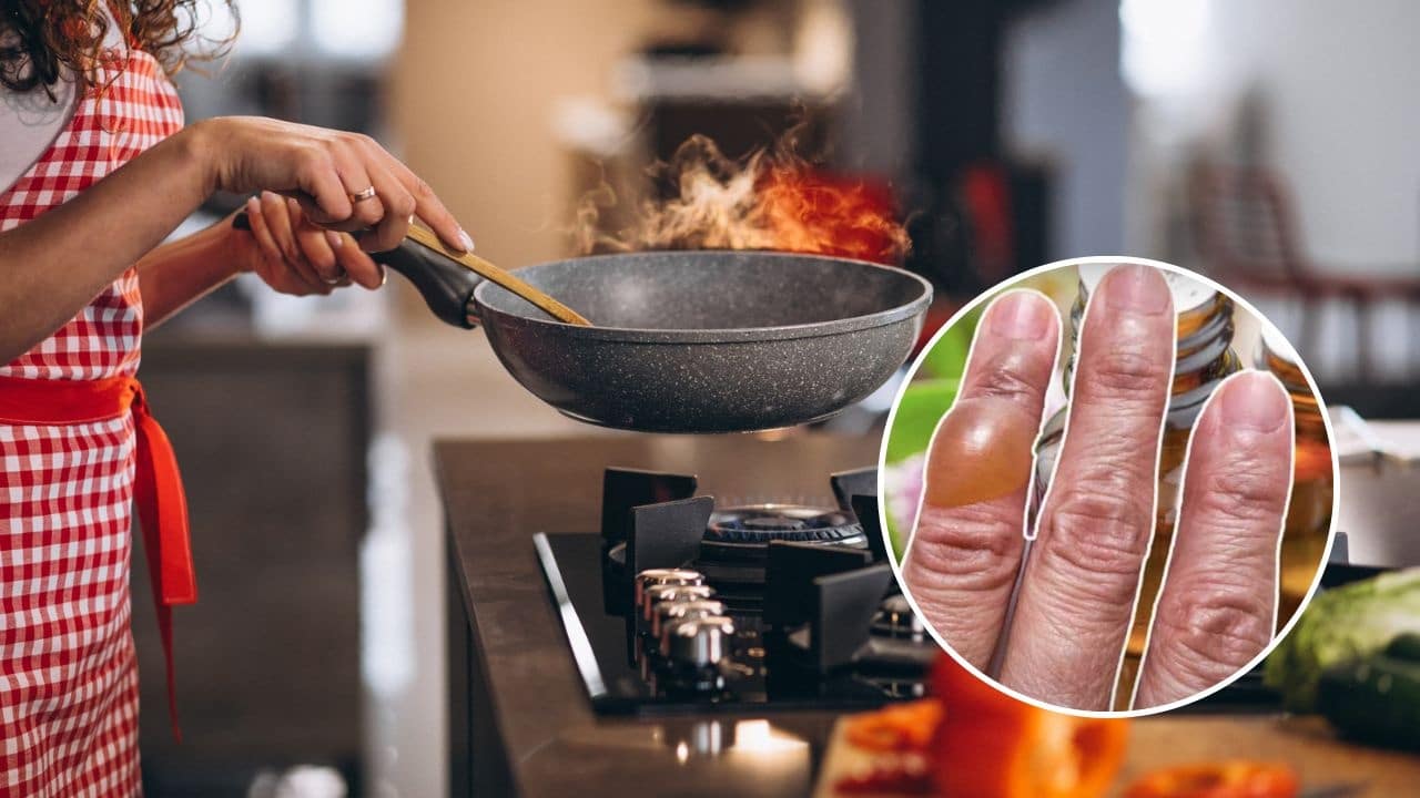 quemaduras de aceite