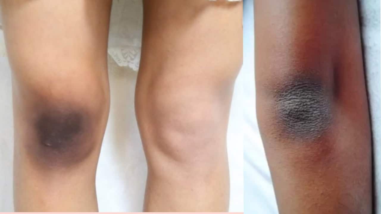 Remedios caseros para aclarar codos y rodillas