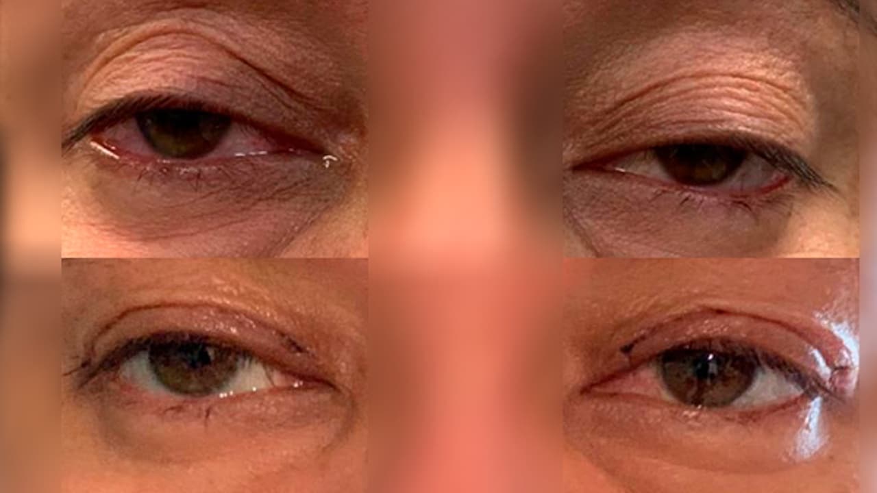 ejercicios para levantar los parpados caidos