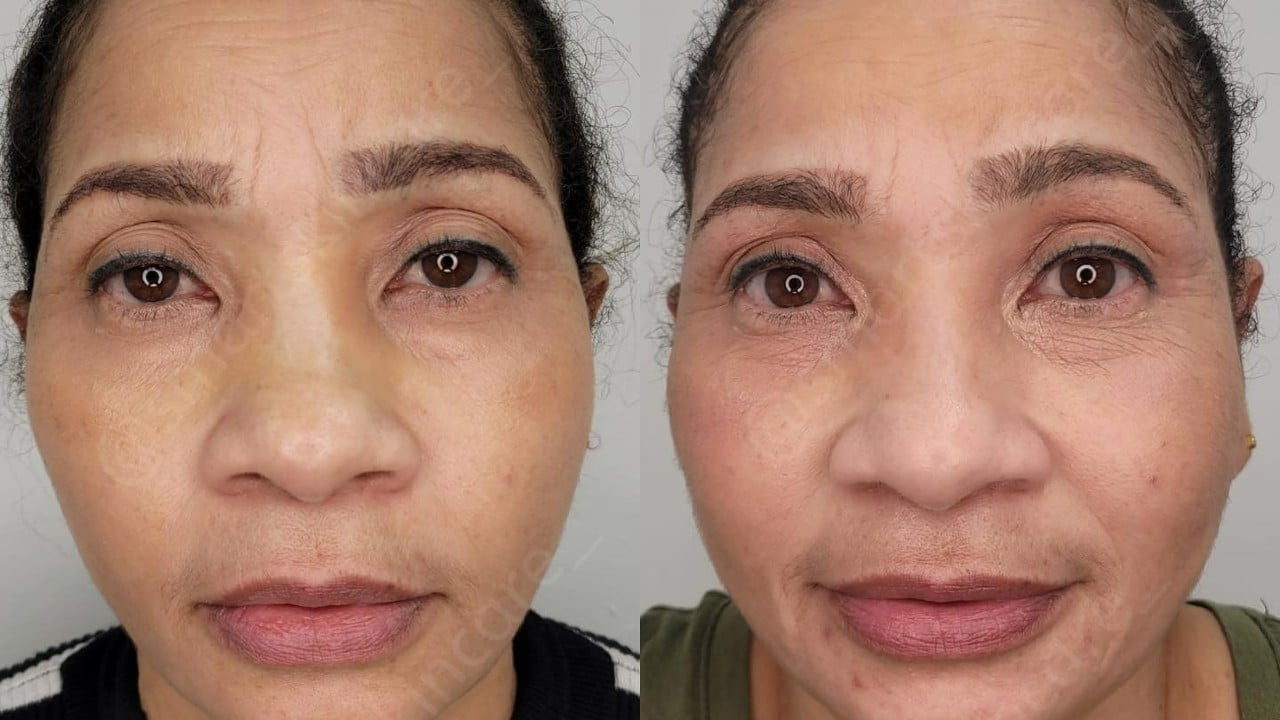 levantar los párpados caídos