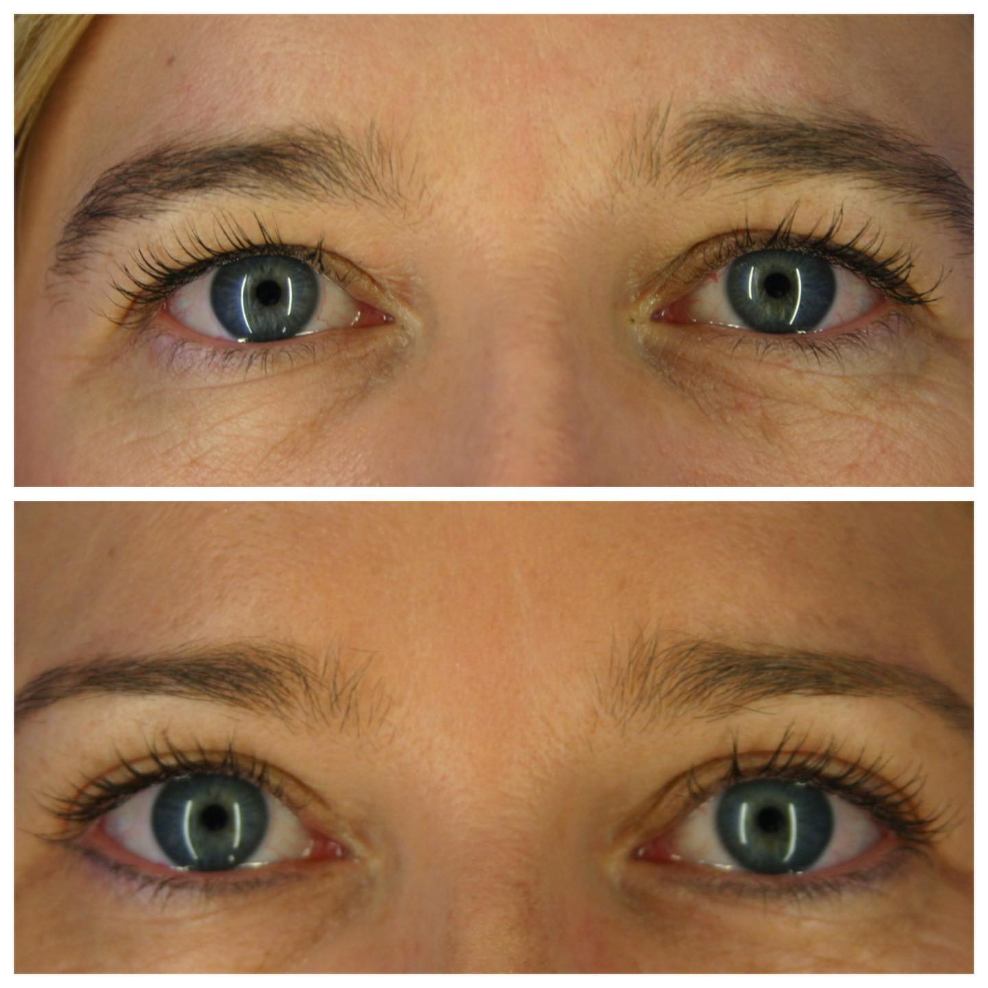 como levantar los parpados caidos de forma natural