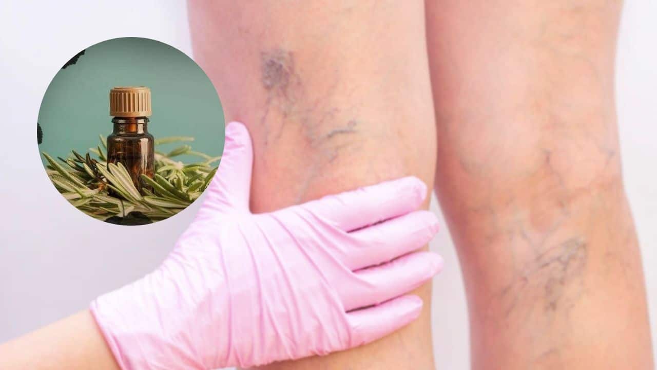 alcohol de romero varices