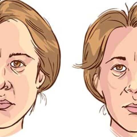 Lo que no debes hacer si tienes parálisis facial