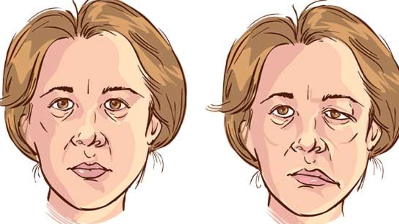 Lo que no debes hacer si tienes parálisis facial