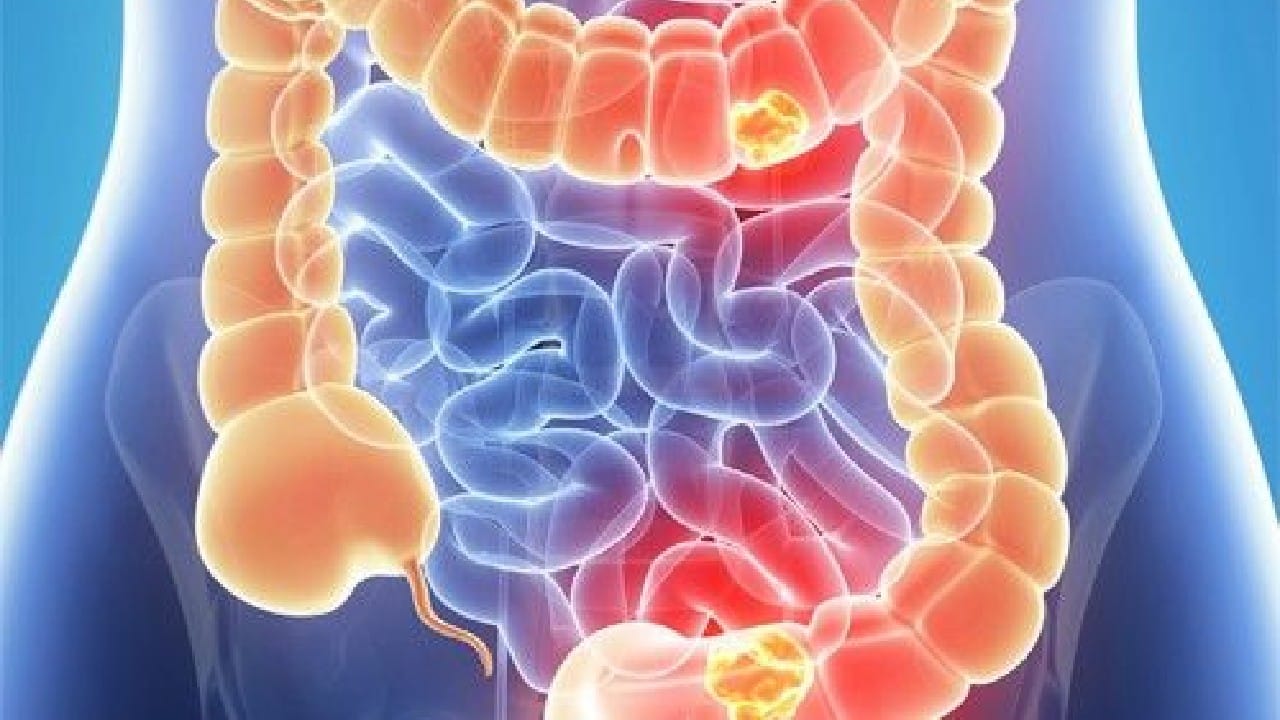 signos de cancer de colon