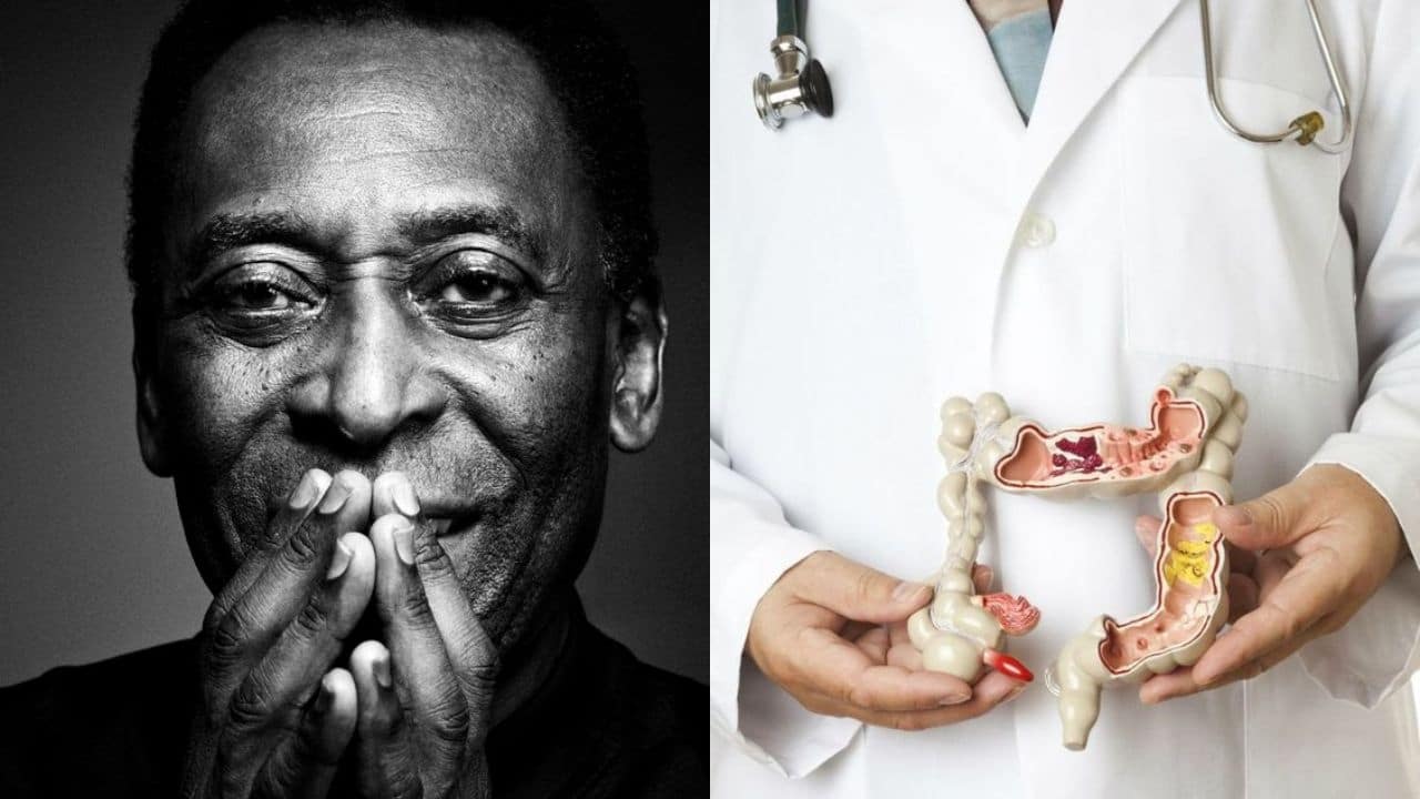 sintomas cancer de colon