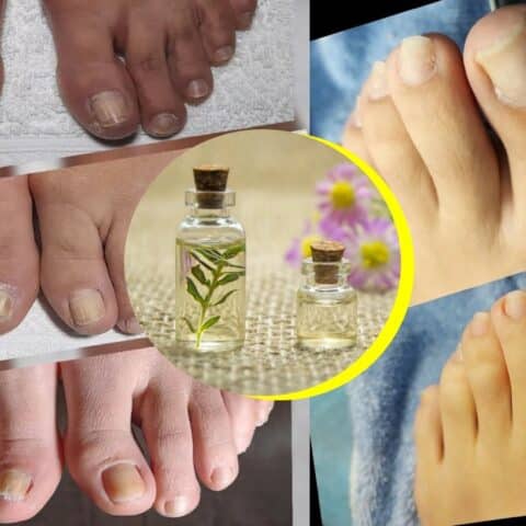Aceites esenciales para los hongos en los pies
