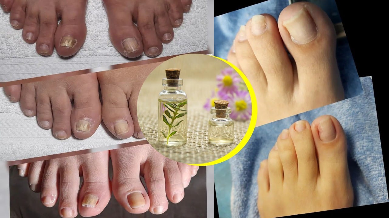 Aceites esenciales para los hongos en los pies