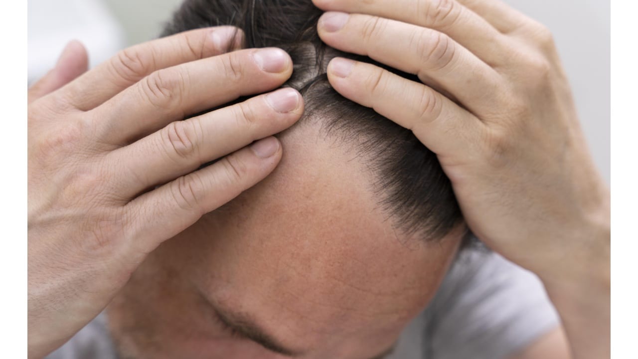 Bebidas que aumentan el riesgo de calvicie y depresión