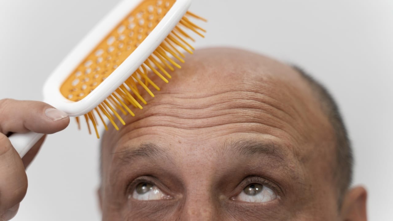 Bebidas que aumentan el riesgo de calvicie y depresión