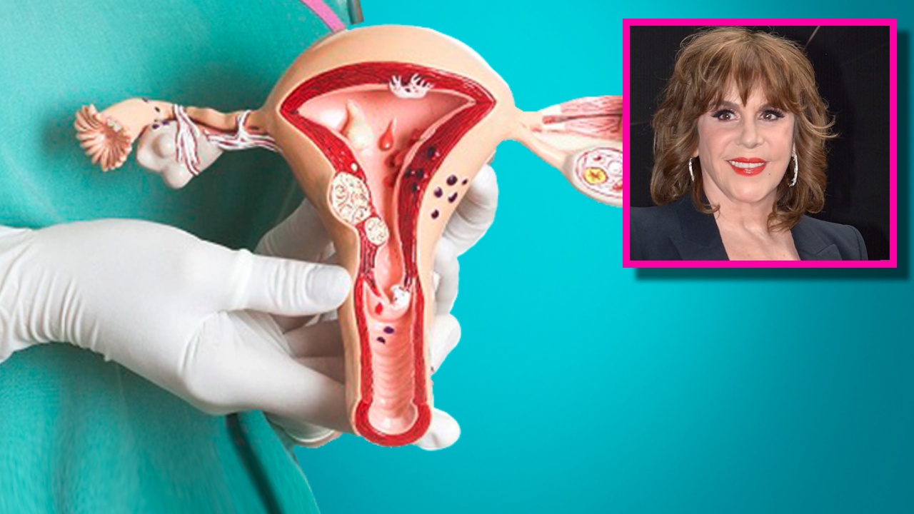 Síntomas de cáncer de ovario