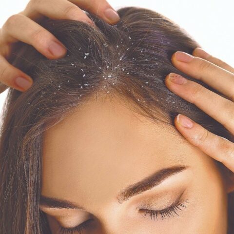 Elimina caspa del cabello
