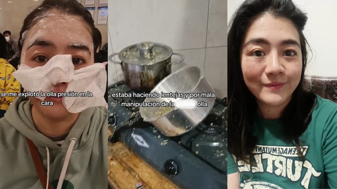 Explotó la olla exprés en la cara