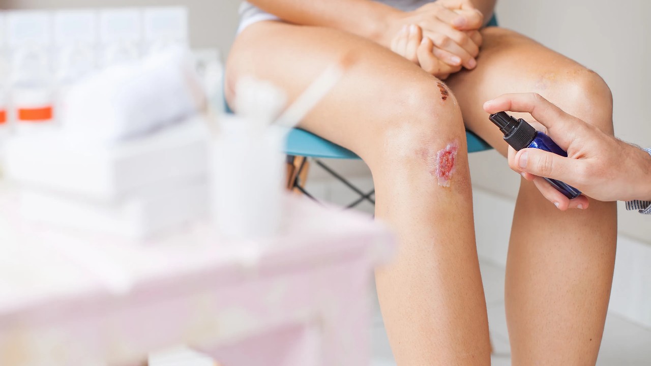 Forma correcta de limpiar heridas