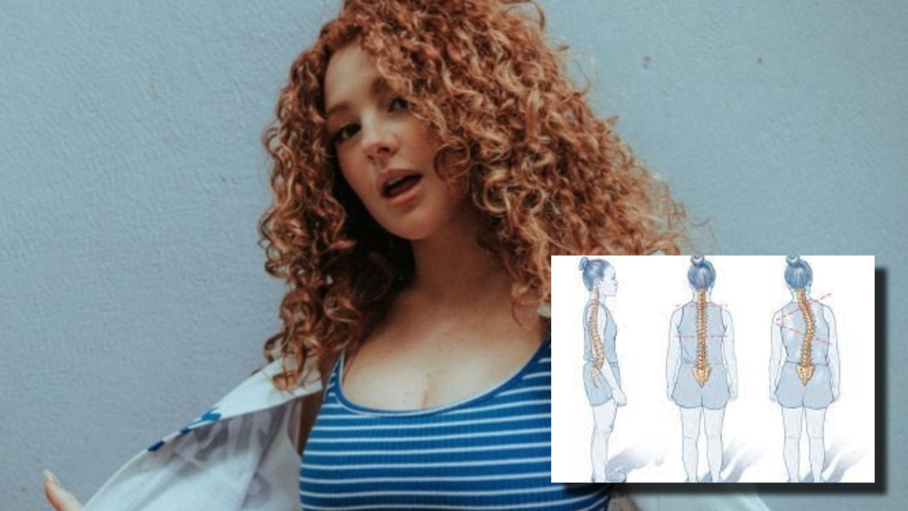 ¿Qué es la escoliosis?