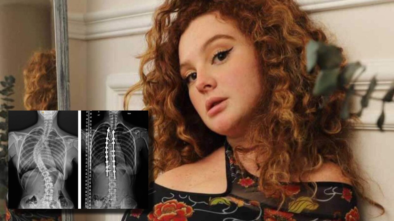 síntomas de escoliosis