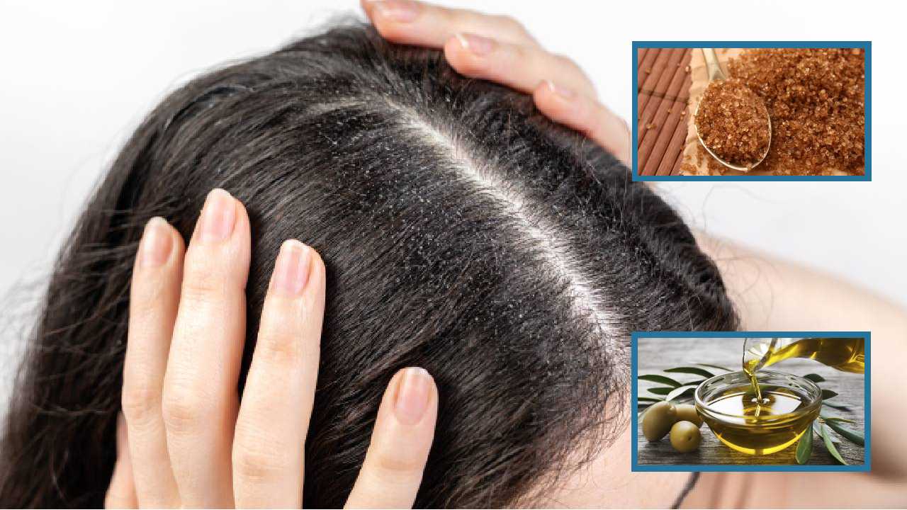 Elimina la caspa de tu cabello