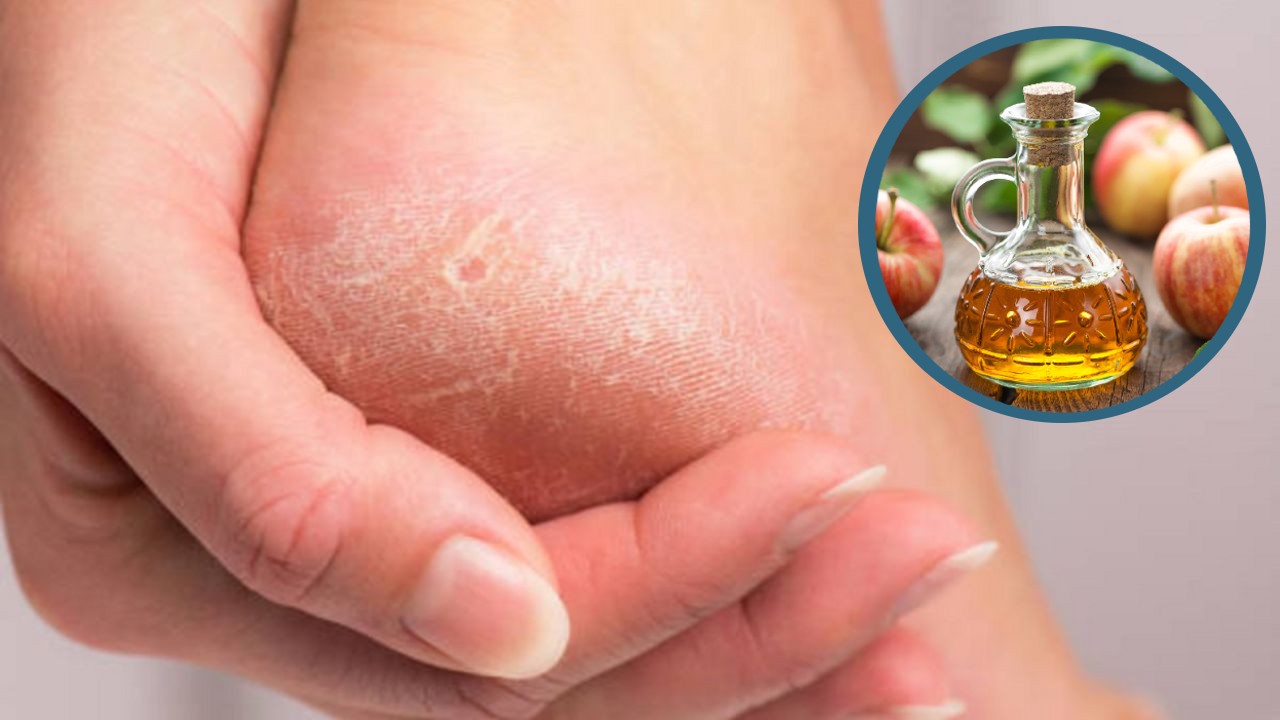 Eliminar talones agrietados con vinagre de manzana