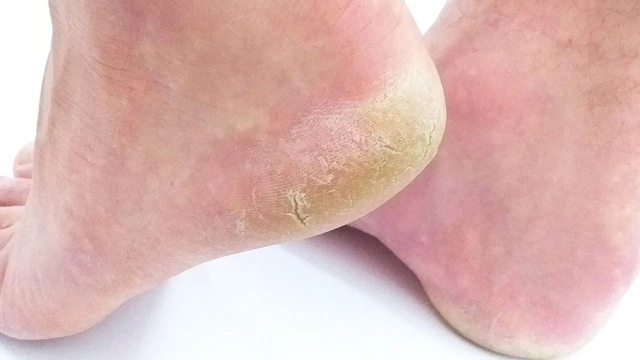 Eliminar talones agrietados con vinagre de manzana